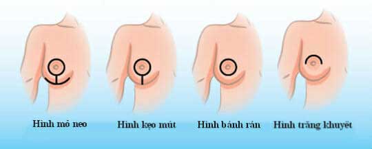 Các cấp độ ngực chảy xệ và phương pháp xử lý từng trường hợp