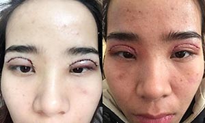 cắt mí mắt quá dài.