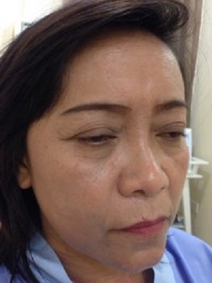 nâng cung chân mày