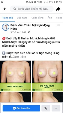 treo ngực sa trễ